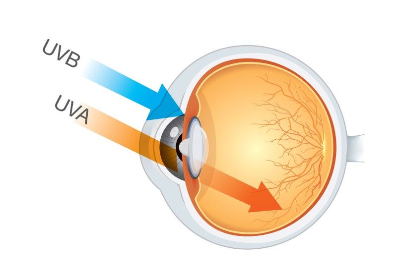 Efecto de los rayos ultravioleta sobre el órgano de la visión: los ojos - Protégete con lentes de sol en Margarita, Venezuela - Visita Solovisión, tu óptica de confianza